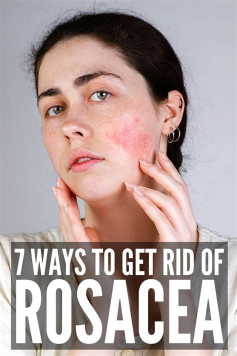 how to cure rosacea naturally.